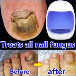 Fungus Nail Laser Device...